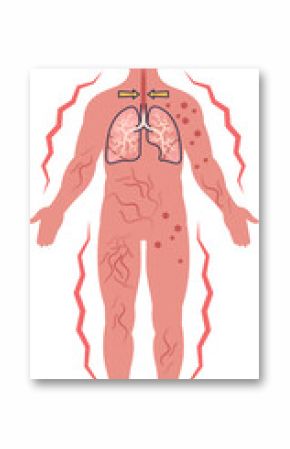 Medical illustration of systemic anaphylaxis symptoms. Shows a human figure with skin rash, hives, and respiratory distress, indicating a severe, body-wide allergic reaction and anaphylactic shock.