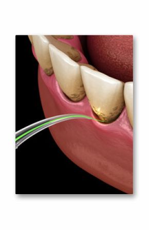 Gum correction surgery with laser.  Dental 3D illustration