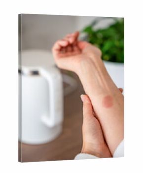 Close up view of scald burn on a hand caused by steam from a kettle in a kitchen. Domestic accident illustrating the danger of hot appliances.