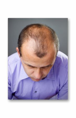 Loosing hair
