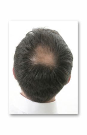 Tonsure-perte de cheveux