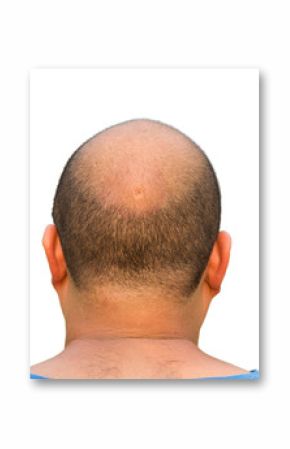 Bald head isolation