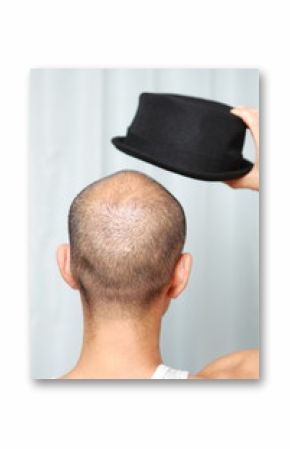 帽子をかぶる薄毛の男性