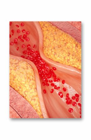 3d illustration of narrowed blood vessel due to atherosclerosis, Symptoms of high cholesterol in the blood