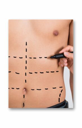 Person Hands Drawing Correction Lines On Abdomen