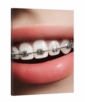 Beautiful macro shot of white teeth with braces. Dental care photo. Beauty woman smile with ortodontic accessories. Orthodontics treatment. Closeup of healthy female mouth