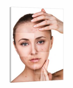 Woman with problem skin on her face