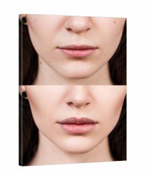 Lips of young woman before and after augmentation