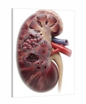 3d illustration of a diseased kidney, showcasing lesions and internal structures.