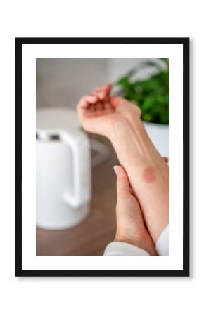 Close up view of scald burn on a hand caused by steam from a kettle in a kitchen. Domestic accident illustrating the danger of hot appliances.