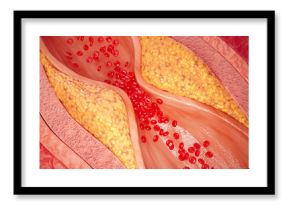 3d illustration of narrowed blood vessel due to atherosclerosis, Symptoms of high cholesterol in the blood