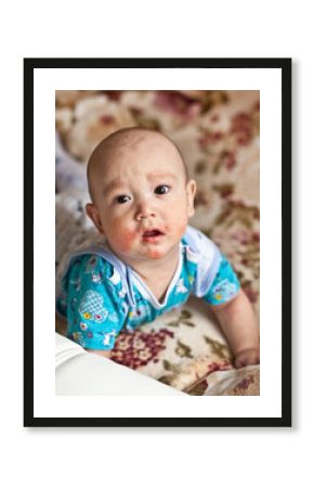 Baby with eczema on face