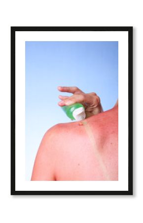 A woman applying Aloe Vera gel on her burned shoulder