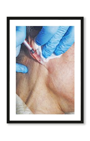 Dermatologist cosmetologist applies cosmetic injection of botox on a middle-aged patient at beauty clinic
