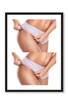 Hips after stretch mark removal treatment