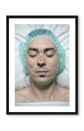 man about to have a rhinoplasty