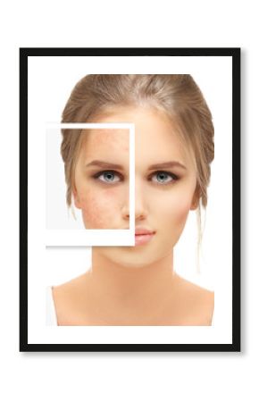 Post-Acne Marks /Treating Acne Scars