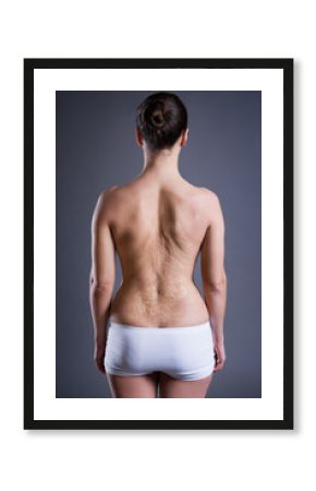 Woman with a large scar after burn on the back