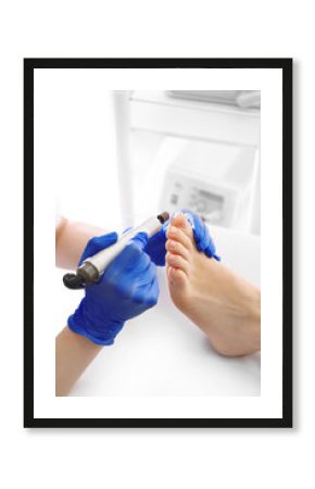 Pedicure leczniczy.Lekarz  usuwa frezarką  odcisk na stopie