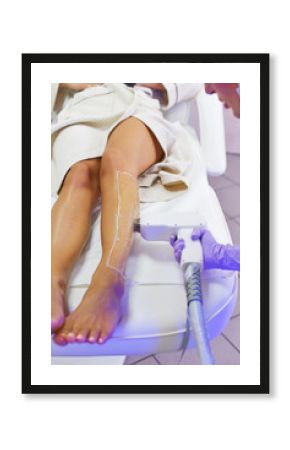 Epilation with diod laser