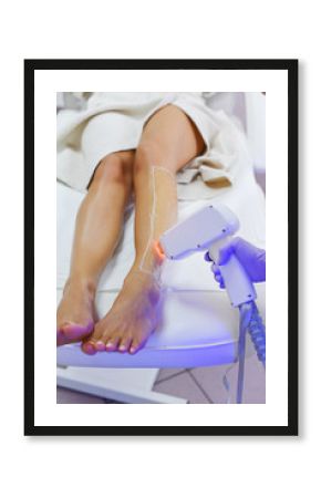 Epilation with diod laser