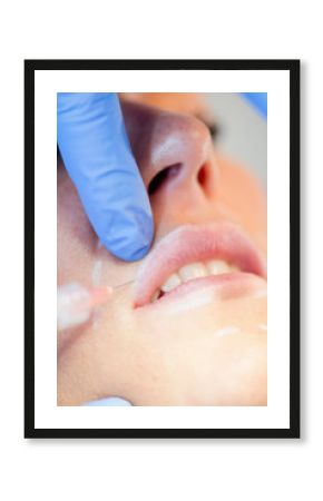 Hyaluronic acid lip treatment
