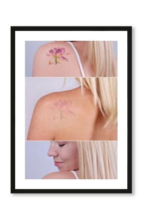Laser tattoo removal before and after. Beautiful young woman with tattoo on her back