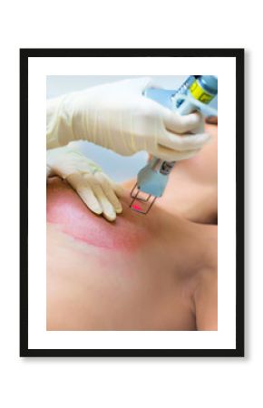 Laser removal of stretch marks on the skin breast