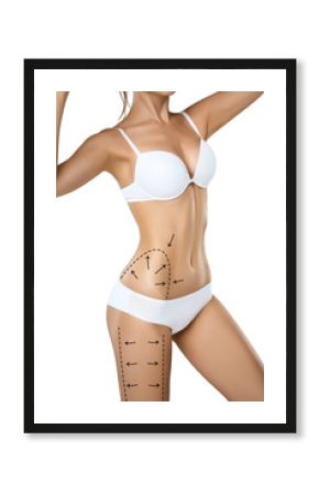 Woman torso in underwear with medical marks for plastic surgery or liposuction