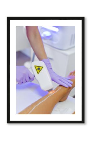 Epilation with a diode laser, hair removal with laser