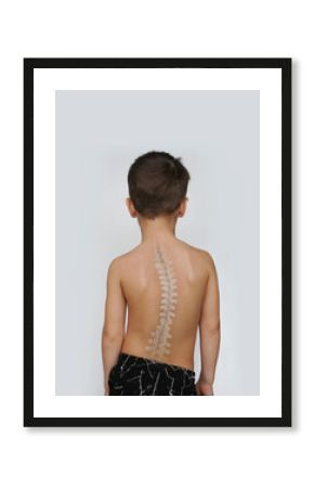 Scoliosis Spine Curve Anatomy, Posture Correction. Child with a deviated spine