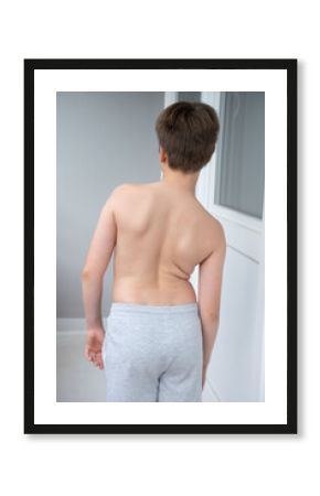 Child's back showing spinal curvature comparison, scoliosis pain, kyphosis, orthopedic treatment or physical therapy, Posture correction for growing bodies and spinal health
