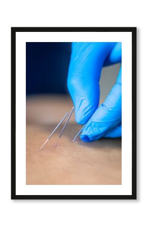 Close up of a needle and hands of physiotherapist doing a dry needling.